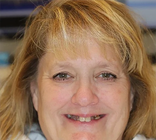 Before: a woman, an actual Smile Arkansas patient, before treatment.