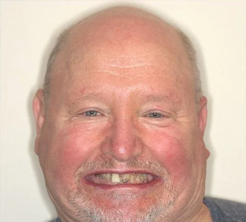 Before: a man, an actual Smile Arkansas patient, before treatment.