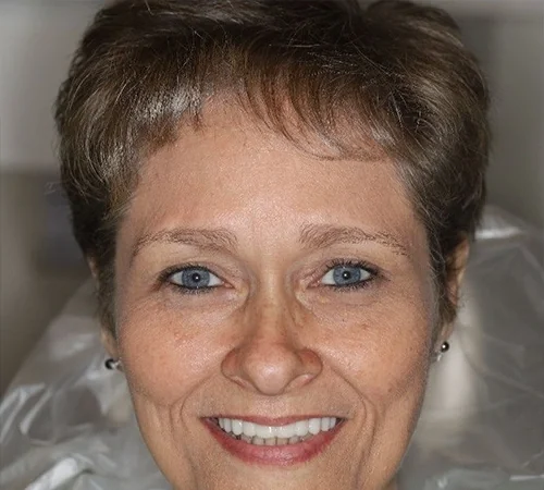 After: the same patient after treatment at Smile Arkansas.