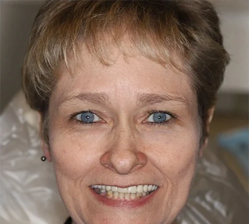 Before: a woman, an actual Smile Arkansas patient, before treatment.