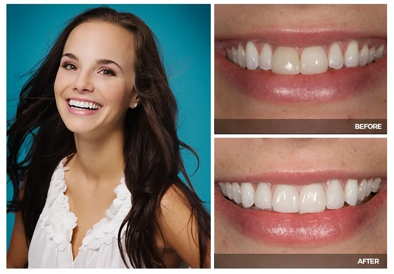 A young woman smiling, with close-ups of her teeth before and after cosmetic treatment at Smile Arkansas.