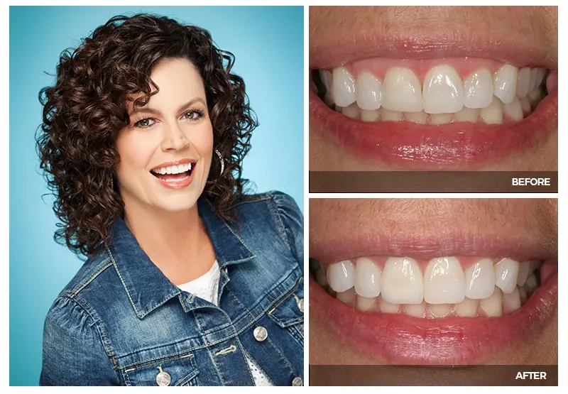 A woman with curly hair smiling, with close-ups of her teeth before and after cosmetic treatment at Smile Arkansas.