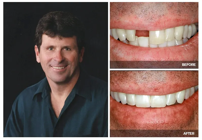 A man smiling, with close-ups before and after his missing front tooth was replaced at Smile Arkansas.