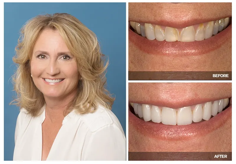 A woman smiling, with close-ups of her teeth before and after cosmetic treatment at Smile Arkansas.